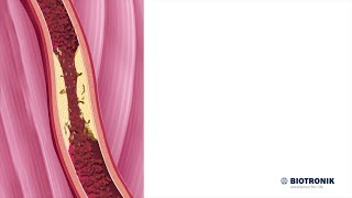 Aterosclerosi e angiografia