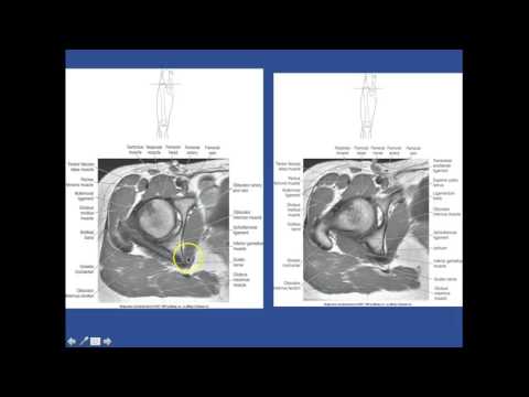 RADT 241 Hip to Femur
