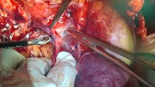 V07-01: Renal Tumor with Level IV Thrombus