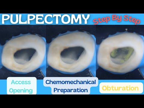 Pulpectomy | Step By Step Demonstration 
