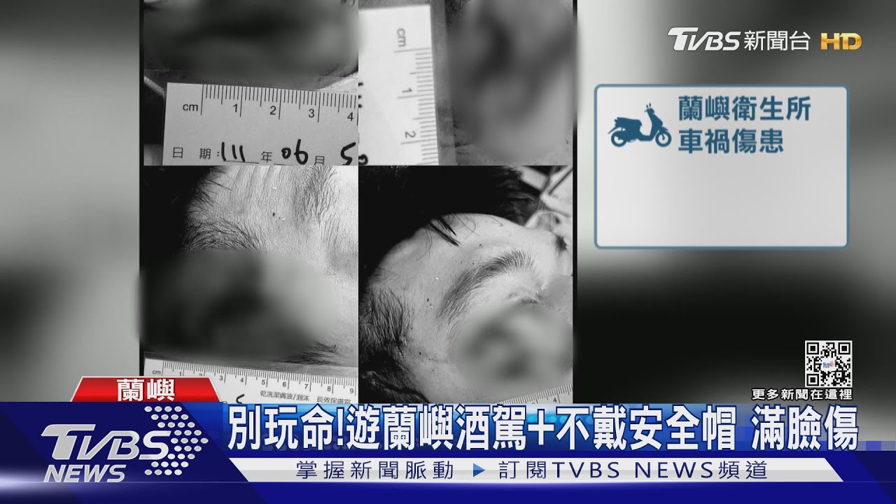 別玩命！遊蘭嶼酒駕+不戴安全帽　滿臉傷