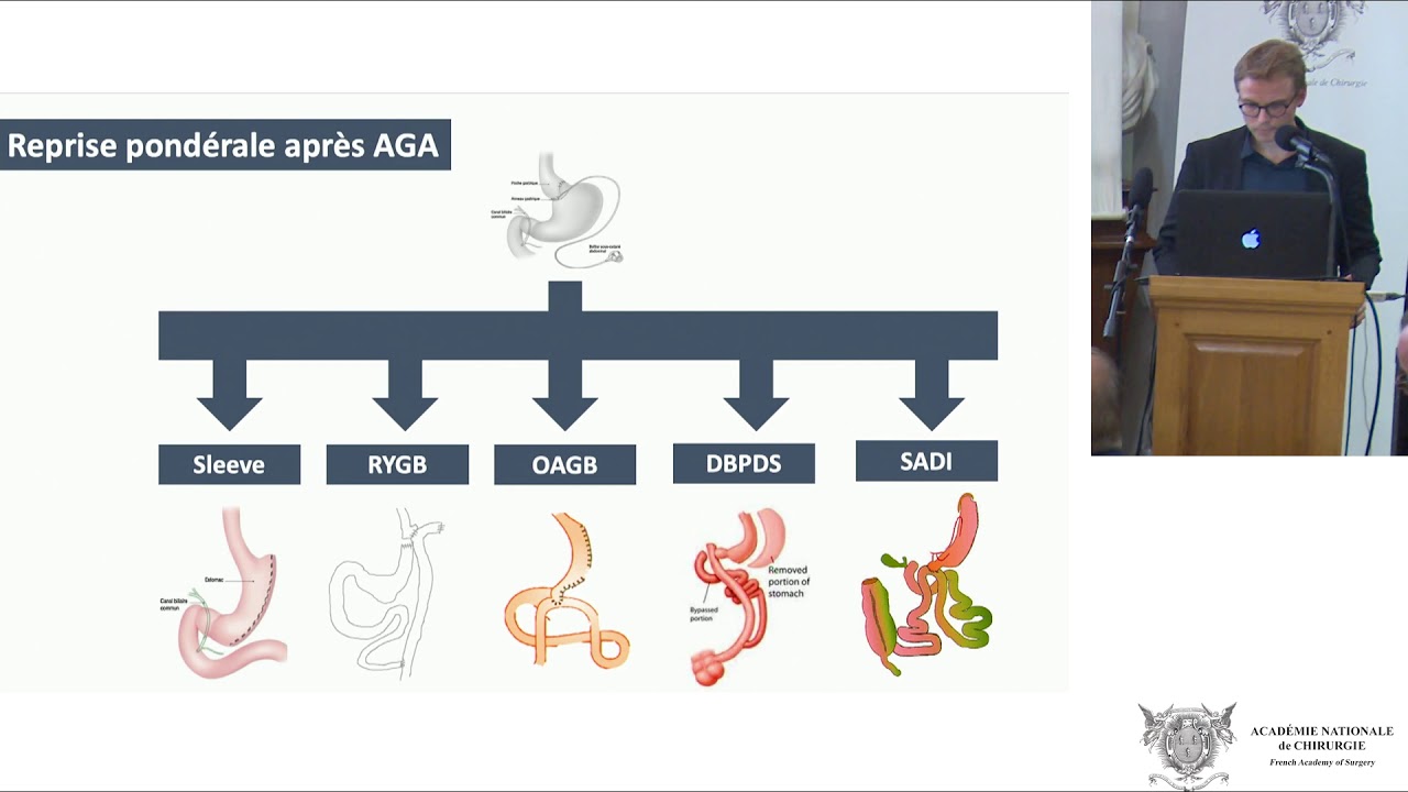 Révision des principales interventions de chirurgie de l'obésité