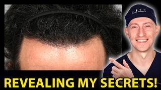 THIS Is The Difference Between A Good And A Bad Hair Transplant...