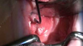 Reducción amigdalar por radiofrecuencia