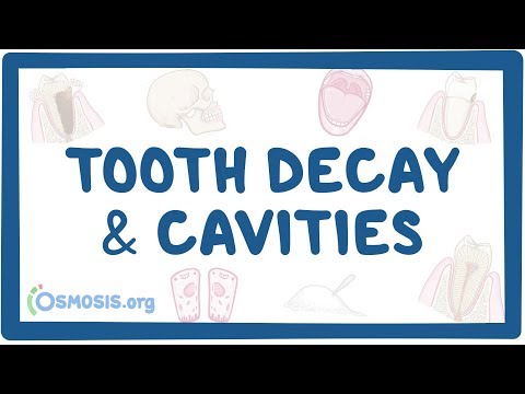 Tooth decay and cavities - causes, symptoms, diagnosis, treatment, pathology