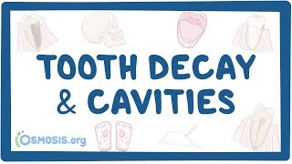 Tooth decay and cavities - causes symptoms diagnos
