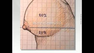 Evolução Da Prótese De Silicone De Mama Com O Tempo