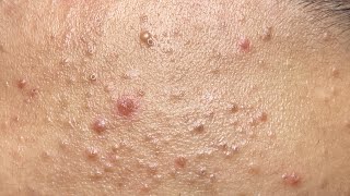 Soothing Facial Treatment for Acne-Prone Skin 646 P4