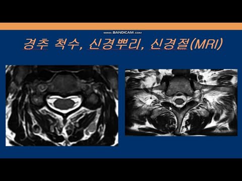 경추 추간판탈출증 협착증 진단