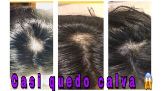 Casi Quedó Calva 😱adiós Caída Del Cabello/Tips De Crecimiento ❤️