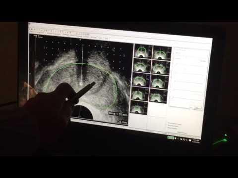 Il trattamento della prostatite cronica a Novosibirsk Prostatite negli uomini ed il video di massaggio