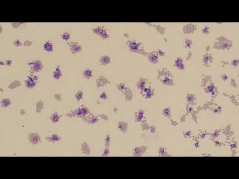 Leukopenia vs Leukocytosis
