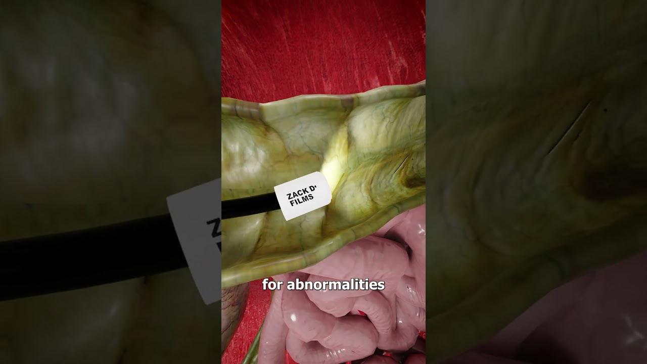 How A Colonoscopy Works 🤔