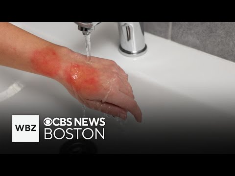 How to properly treat a burn at home