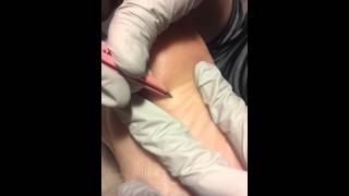 Hair pulled from bottom of foot