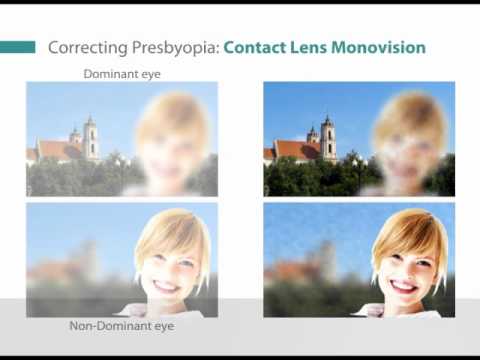 Laser Blended Vision at the London Vision Clinic (in Spanish)