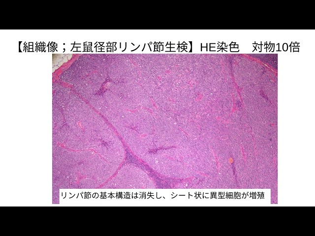 リンパ節捺印細胞診の1例 悪性黒色腫（AI音声あり）