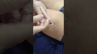 Mesoterapia en rotura fibrilar