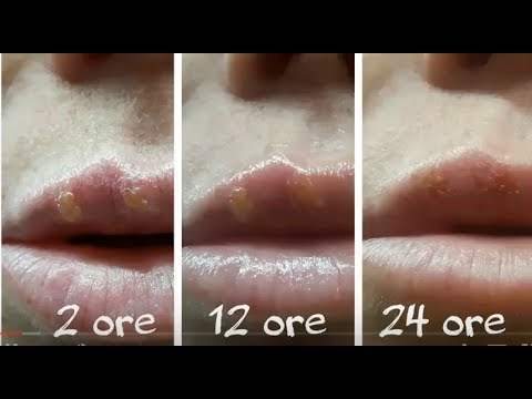 Sbarazzarsi di malattia degenerativa del disco e dolori articolari Non urtare collo osteocondrosi