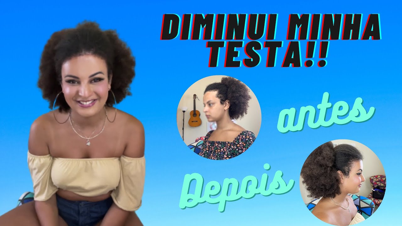 MINHA CIRURGIA DE DIMINUIÇÃO DE TESTA | ANTES e DEPOIS #Frontoplastia