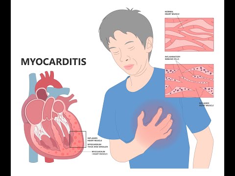 Infectious Myocarditis | Viral, Bacterial & Parasitic Causes – Harrison Simplified