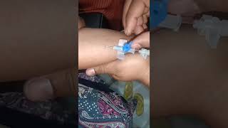 Cannulation.. video.. part 1044 #shorts #viral