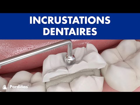 Incrustations dentaires ©
