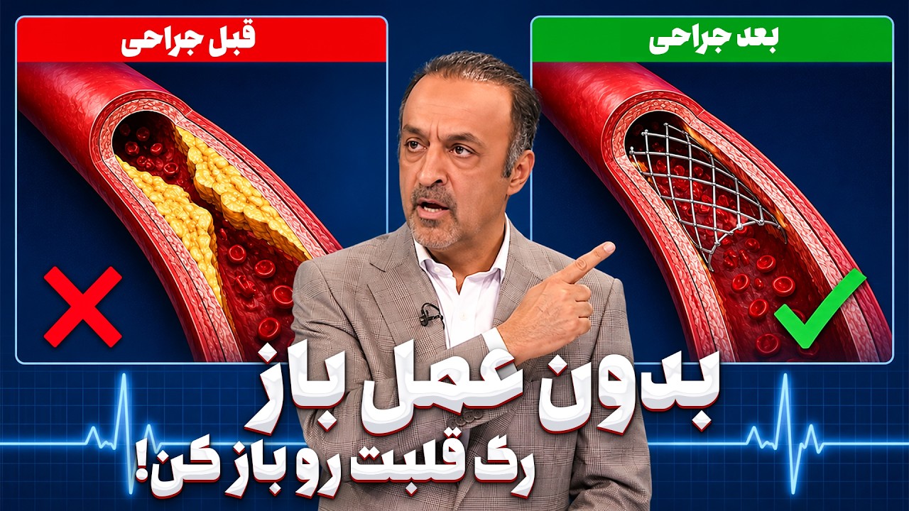 باز کردن گرفتگی رگ قلب بدون عمل جراحی! (روش جدید جایگزین عمل باز)