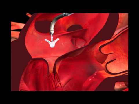 MitraClip Procedure - Nebraska Medicine