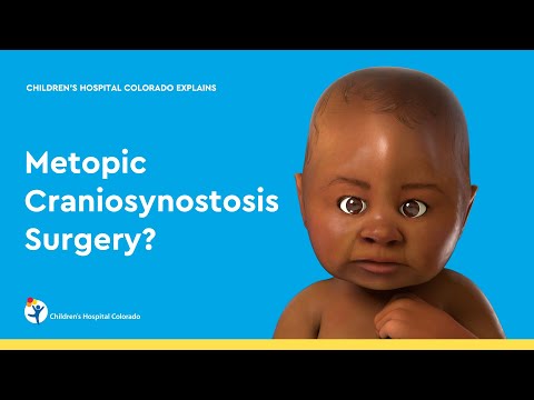 Metopic Synostosis