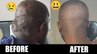 Treating bumps at the back of your head - Acne Keloidalis Nuchae (AKN)