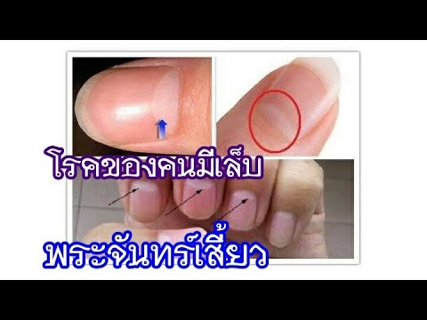 การใช้งานของ prednisolone สำหรับโรคสะเก็ดเงิน ซึ่งเป็นครีมที่ดีกว่าสำหรับโรคสะเก็ดเงิน