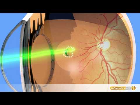 Augen-OP mit Laser: So wird ein Retinariss gelasert