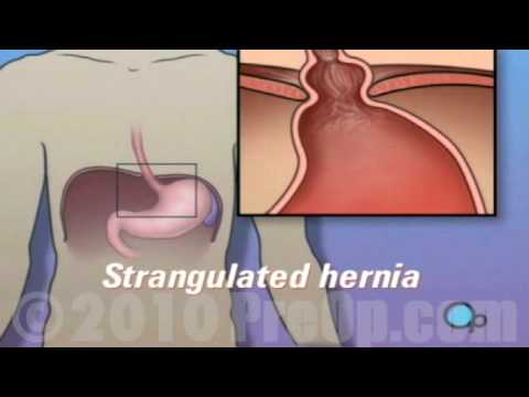 PreOp® Patient Education Hernia - Hiatal Open Repair