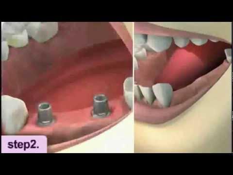 Implant for Crown and Bridge