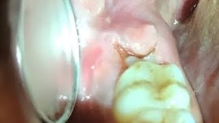 Painful swollen gum around wisdom tooth / molar. Pericoronitis - Cure / Treatment