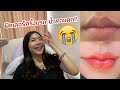 ฉีด ฟิลเลอร์ ปาก