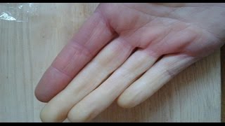 IF YOUR HANDS ARE COLD ALL THE TIME, YOUR HEALTH MAY BE AT SERIOUS RISK
