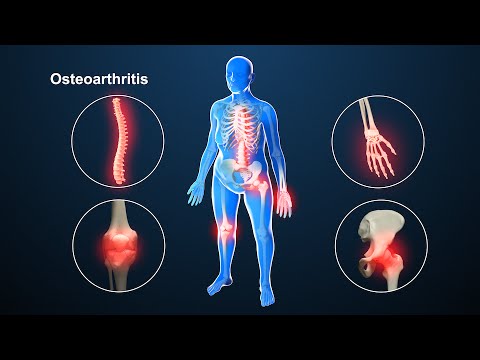 Csípőízület osteoarthritis kezelése 3 fokkal