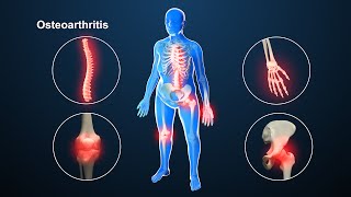 Osteoarthritis | Nucleus Health
