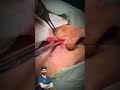 Excision Of Congenital Mole From Face Tayyabriazch