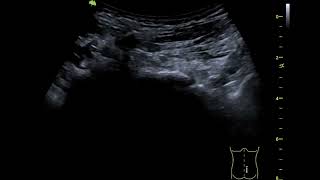 Asvide: Localization of the responsible inferior articular process.