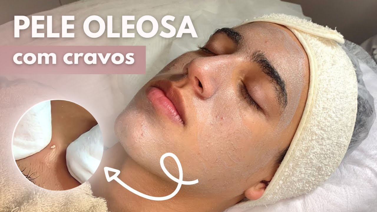 LIMPEZA DE PELE PROFISSIONAL EM ADOLESCENTE #limpezadepele