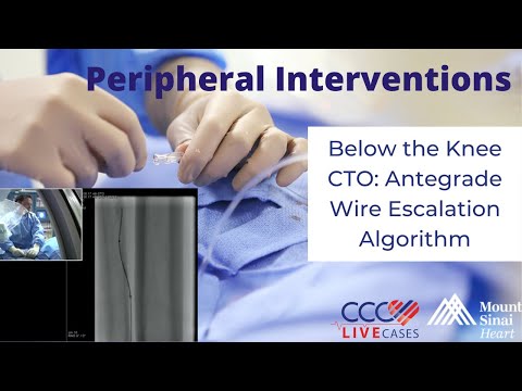 Below the Knee CTO: Antegrade Wire Escalation Algorithm - February 28, 2018