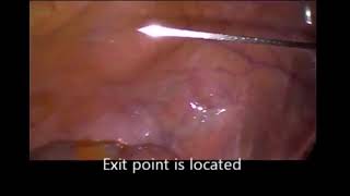 TPEA Lifter - Colon Retraction