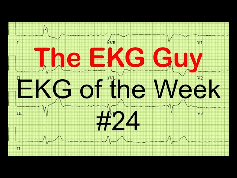 EKG/ECG of the Week #24 | The EKG Guy - www.ekg.md