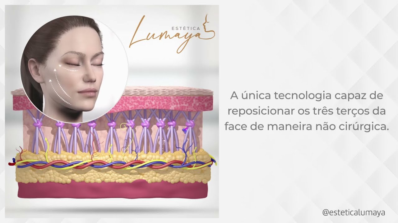 Ultrassom Microfocado - Estética Lumaya