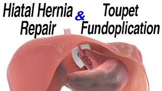 Hiatal Hernia Repair with Toupet Fundoplication to Treat Reflux Animation