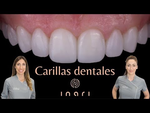 Carillas Dentales
