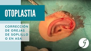Otoplastia: : así es el procedimiento quirúrgico - Dra. Patricia Gutiérrez (Cirujana Plástica) - Dra. Patricia Gutiérrez Ontalvilla